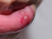 Lở miệng (Nhiệt miệng) - nguyên nhân, triệu chứng và cách chữa trị